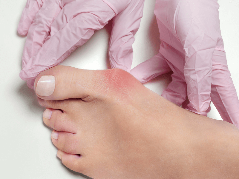 What to Do If You Get a Bunion