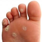 Verruca Needling Verruca Needling