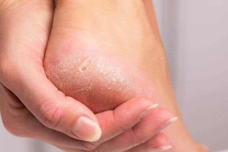 Hyperkeratosis can affect your feet