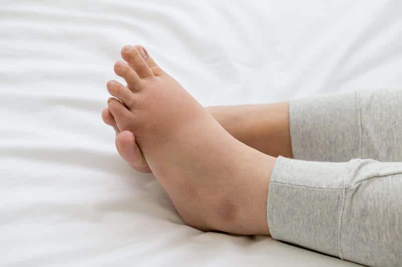 Why Do Your Feet and Ankles Swell?