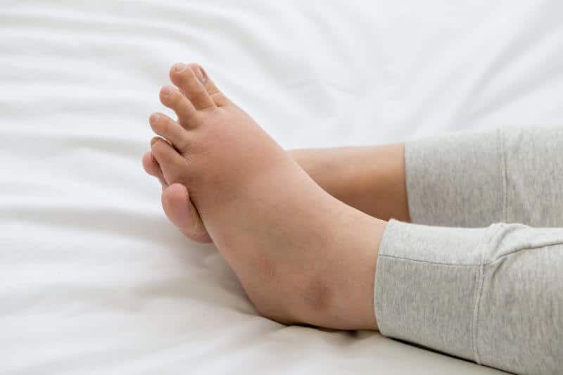 Swollen Feet and Ankles  Why Do Your Feet and Ankles Swell?