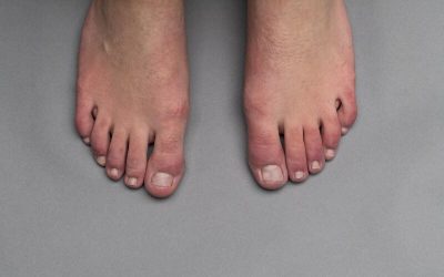 Covid Toe: How Coronavirus Can Affect Your Feet