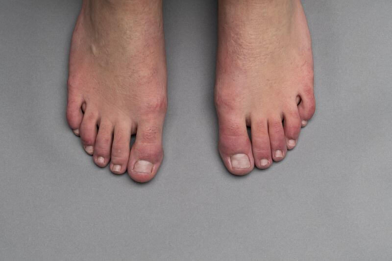 Covid Toe: How Coronavirus Can Affect Your Feet
