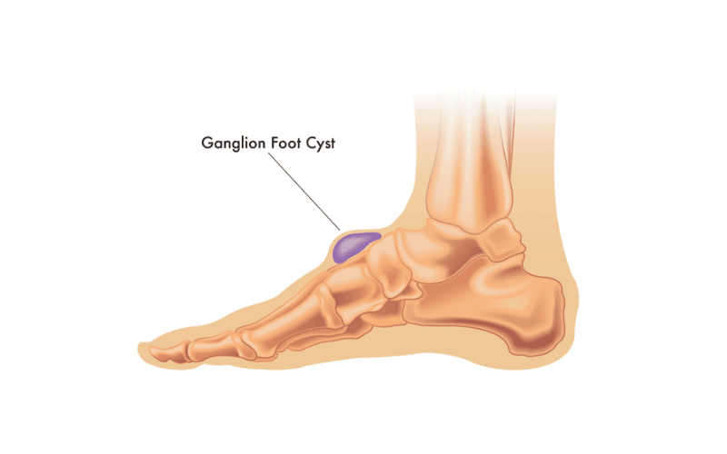 ganglion cyst on a foot