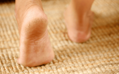 Cracked Heels – More Than Just Dry Skin?