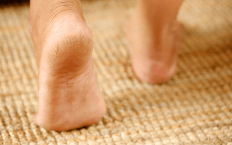 Cracked Heels – More Than Just Dry Skin?