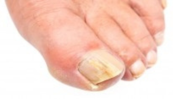 Fungal Nail