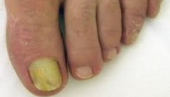 Nail Fungus