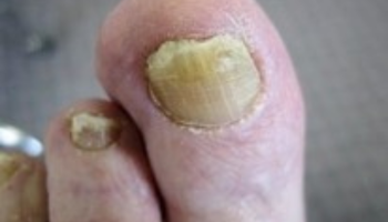 Onychomycosis
