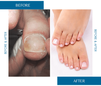 before and after fungal nail treatment.