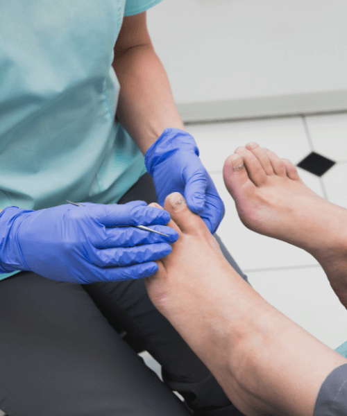 fungal nail treatment